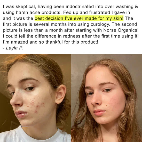 Before-and-after photos showing clearer skin after a blemish treatment