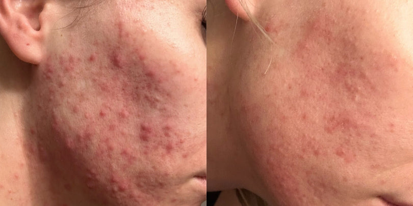 Before-and-after cheek close-ups showing reduced acne and redness after treatment