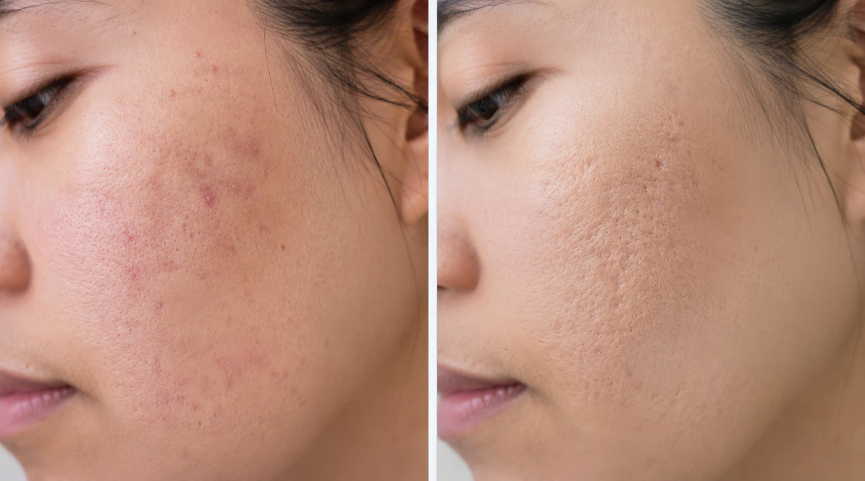 Comparison infographic of acne marks versus acne scars