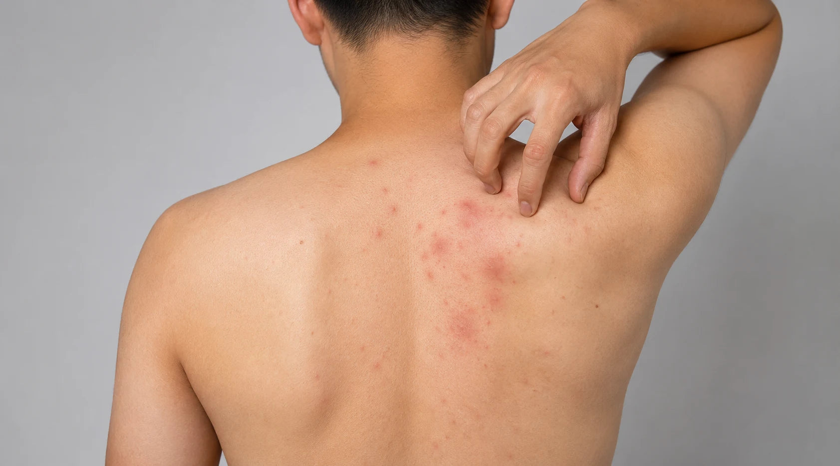 Acne mechanica infographic showing friction-related breakouts