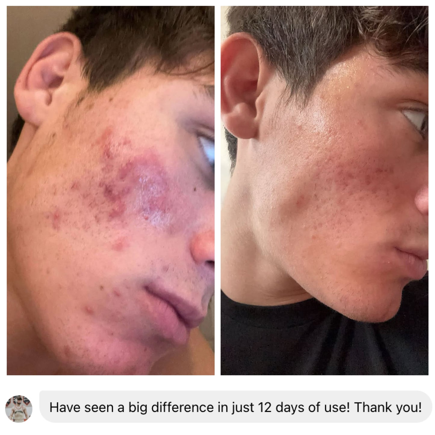 Before and after face photos showing clearer-looking skin after 12 days of Pimple Scars Balm 2.0