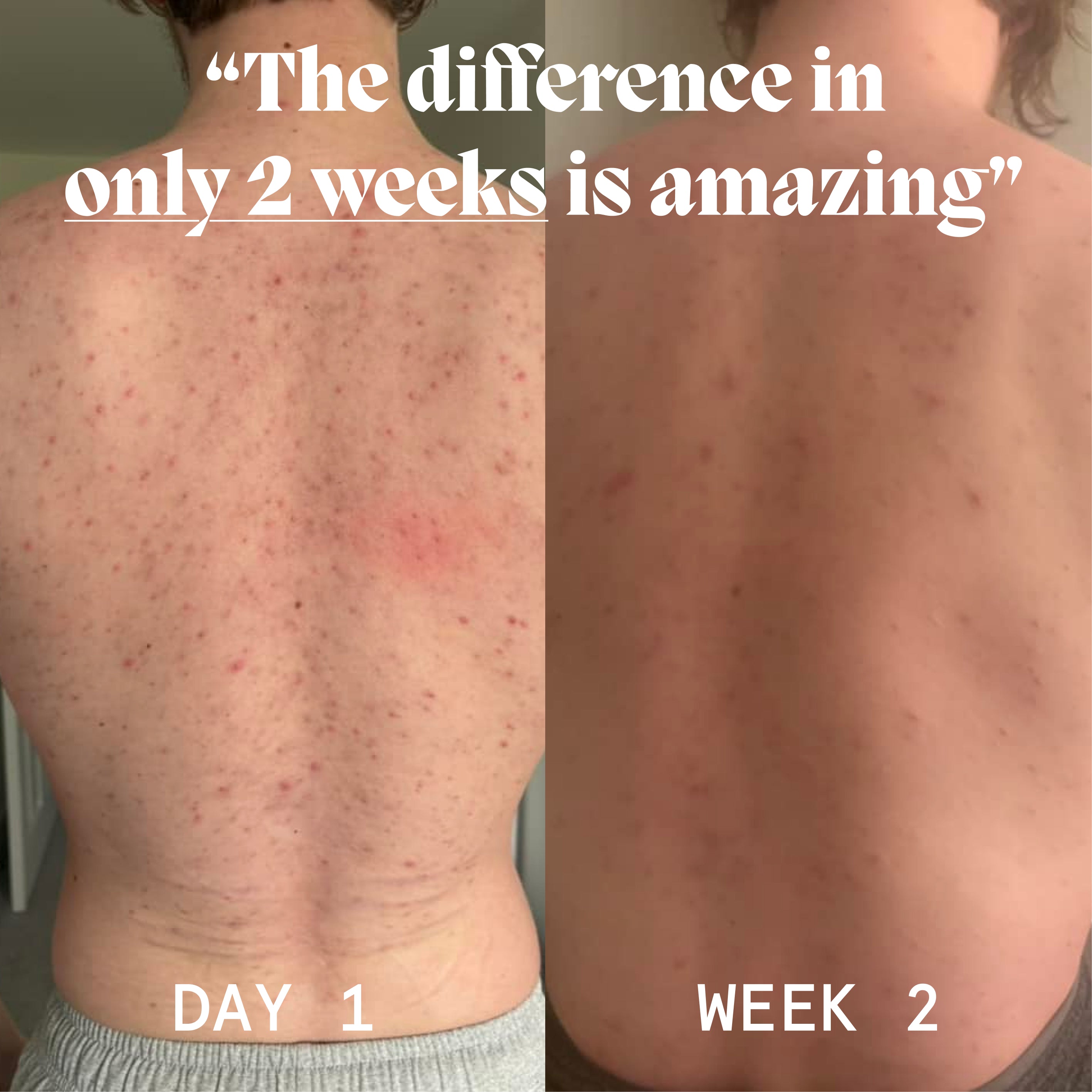 Norse Organics body acne balm shown on skin