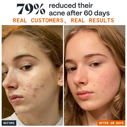 Before and after graphic of a teen's clearer-looking skin after 60 days of Pimple Stopper Night Balm