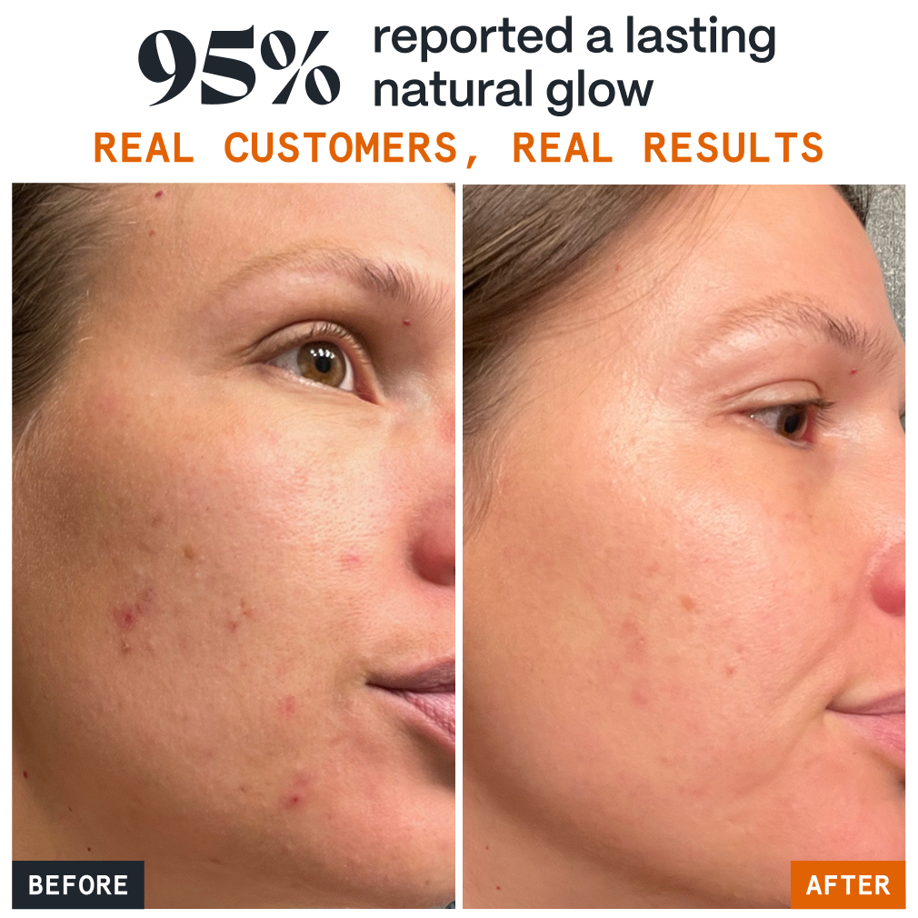 Before and after faces showing clearer-looking skin with Pimple Stopper Day Balm