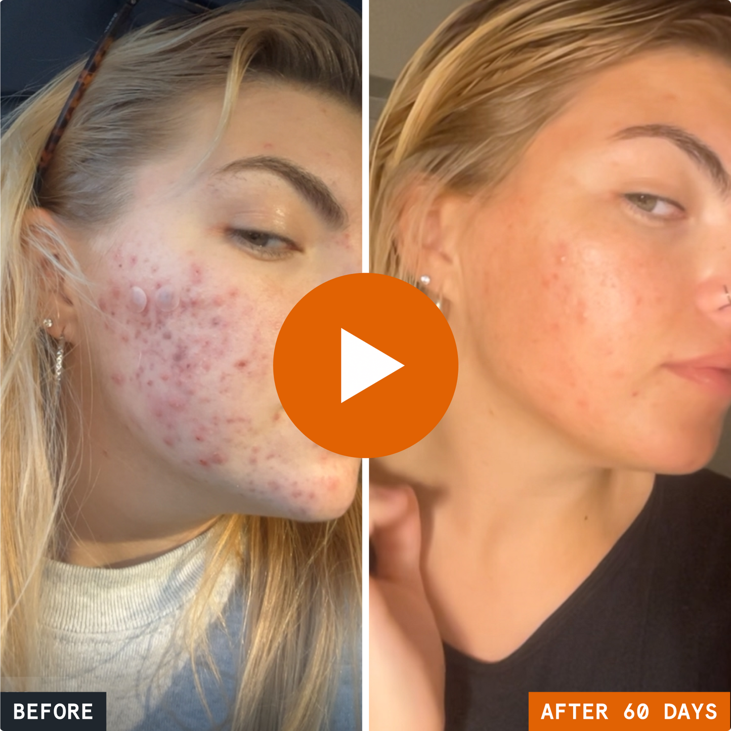 Before and after of a woman's face over 60 days with the Kill Acne & Redness Ritual