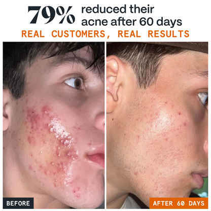 Before and after graphic of a man's clearer-looking skin after 60 days of Pimple Stopper Night Balm