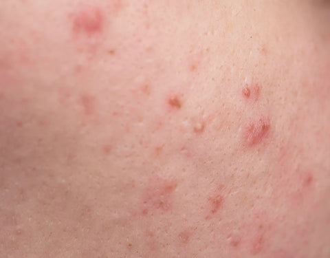 Acne Papules