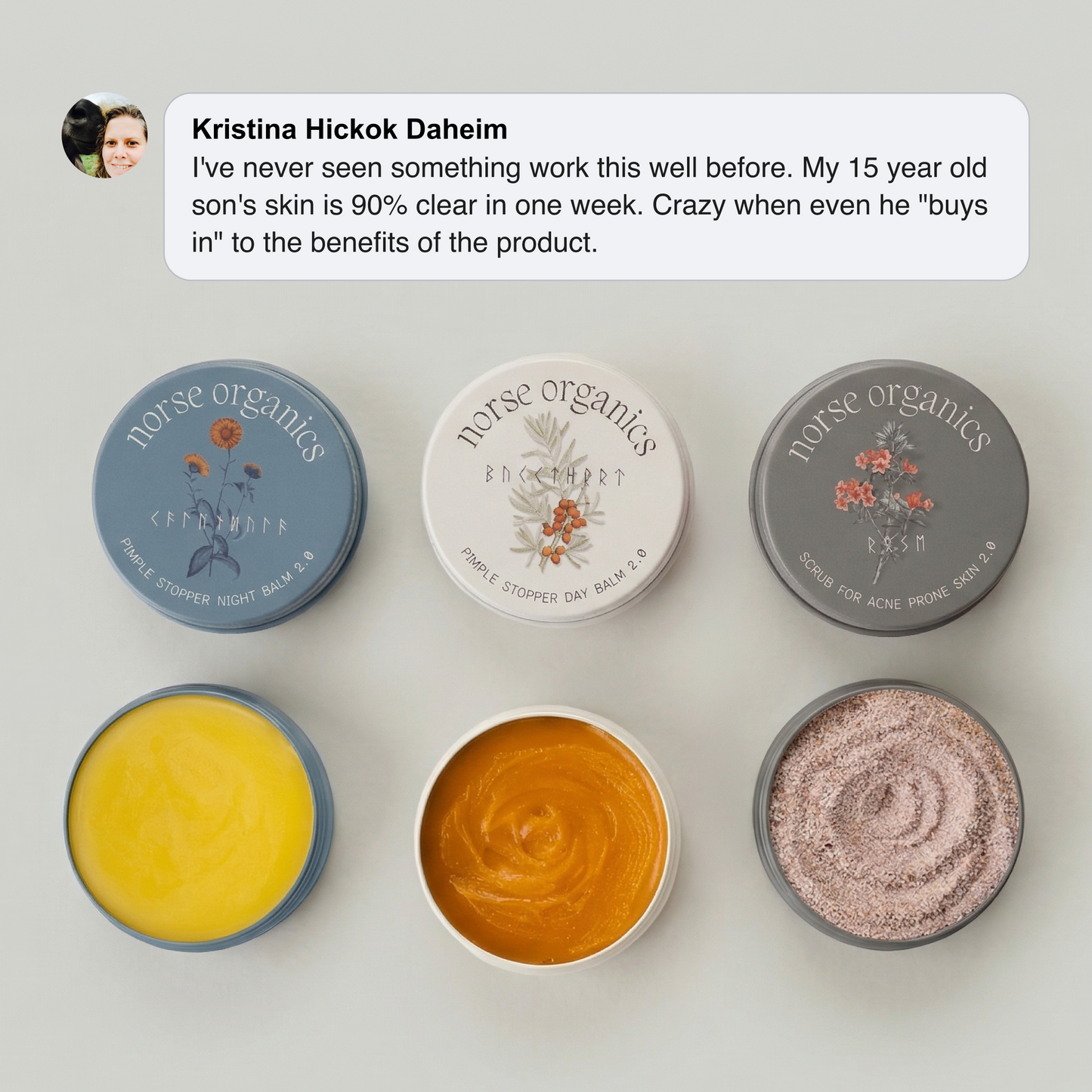 Three open Acne Stopper Starter Pack jars — night balm, day balm and scrub — with a customer testimonial