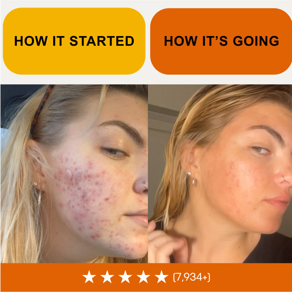 Before and after of a woman's face with the Acne Stopper Starter Pack and a five-star rating
