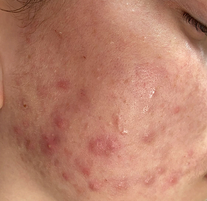 Acne Redness