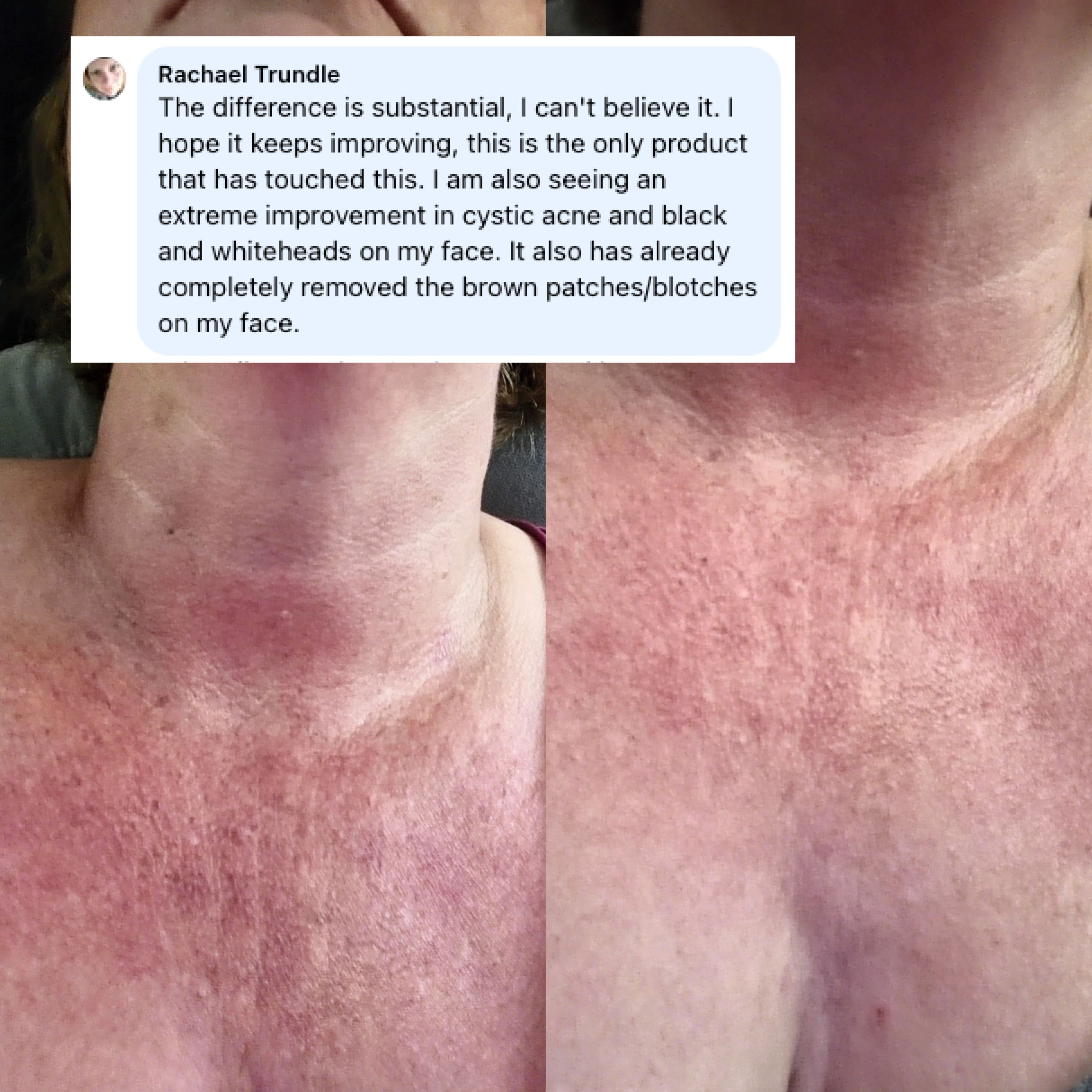 neck acne before and after results
