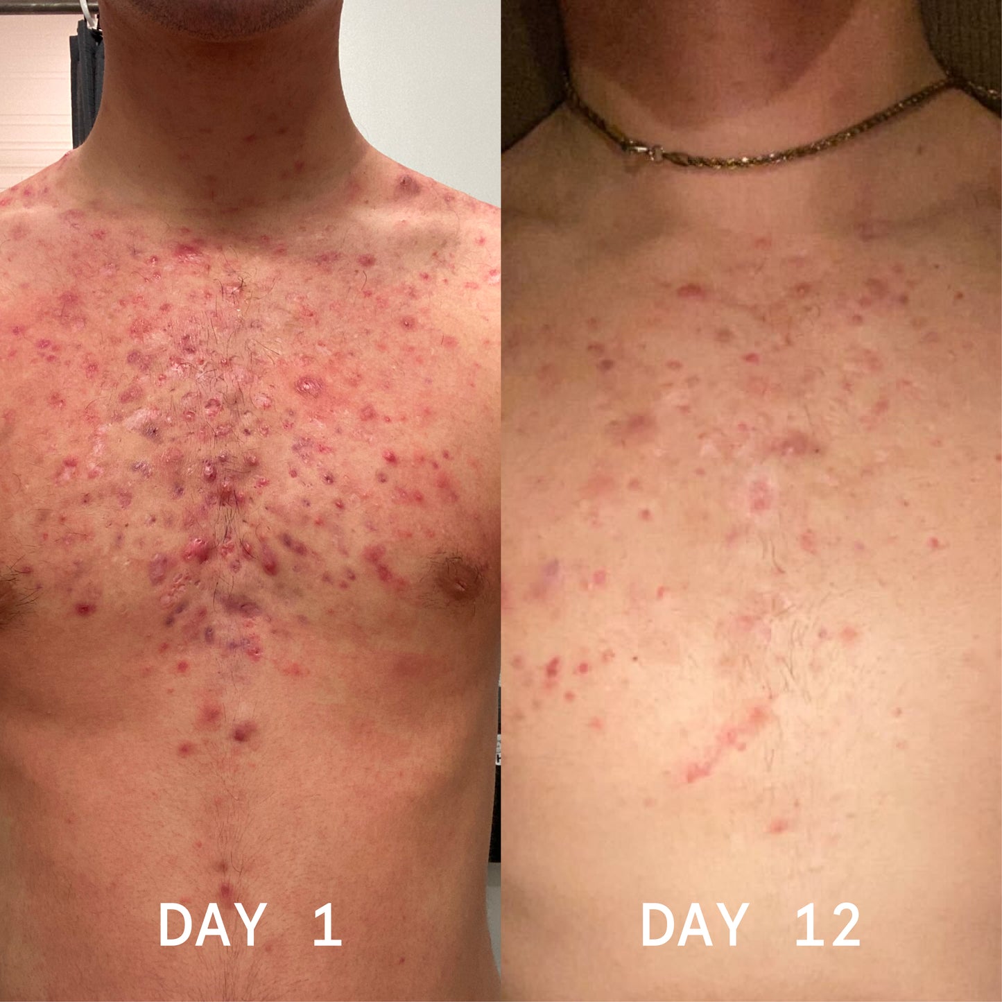 Before and after chest photos, Day 1 to Day 12, showing clearer-looking skin with the body acne balm