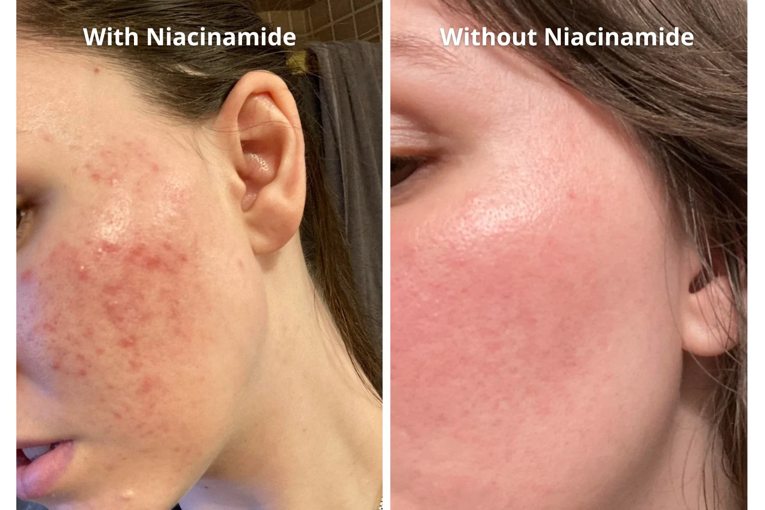 Comparison of skin with niacinamide versus without niacinamide