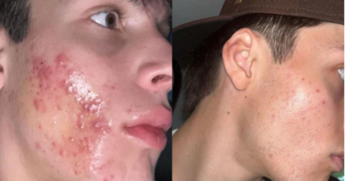 Close-up of acne breakouts on the skin
