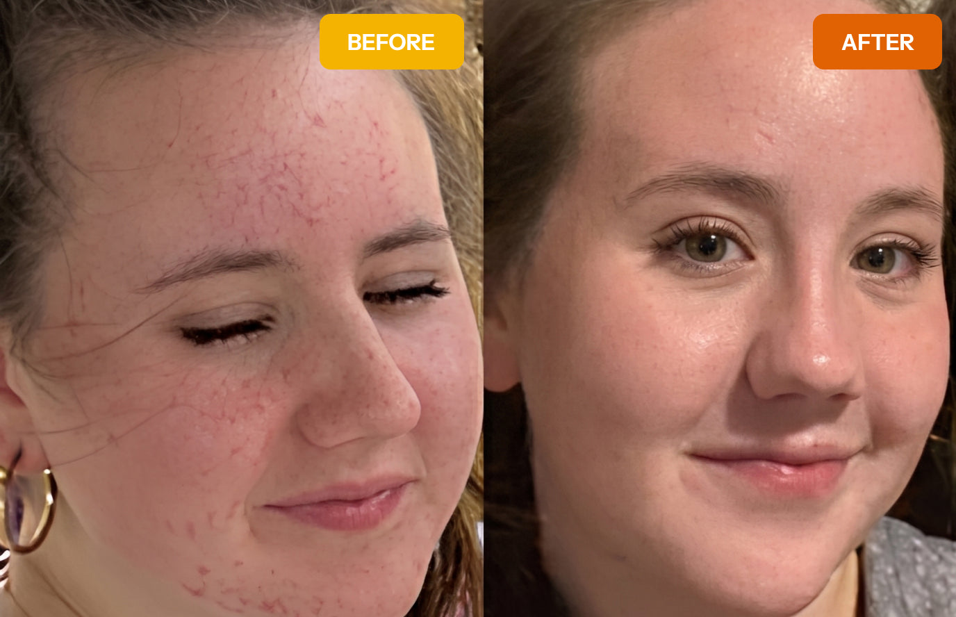 Before-and-after photos showing clearer skin after switching to gentle skincare