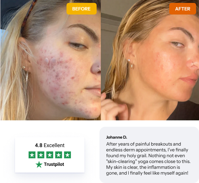 Norse Organics Natural Acne Treatment