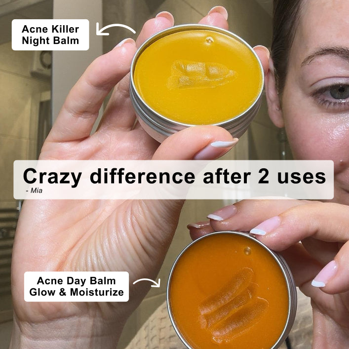 Hands holding open Acne Killer day and night balms with a customer testimonial about quick results