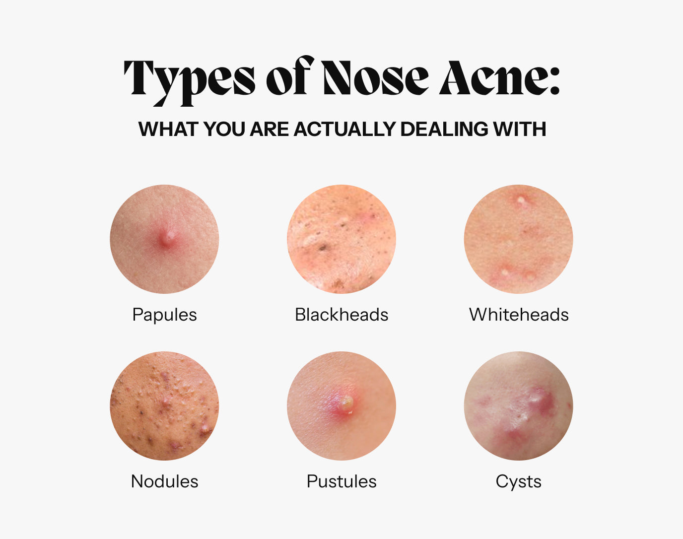 Infographic showing types of nose acne: papules, blackheads, whiteheads, nodules, pustules and cysts