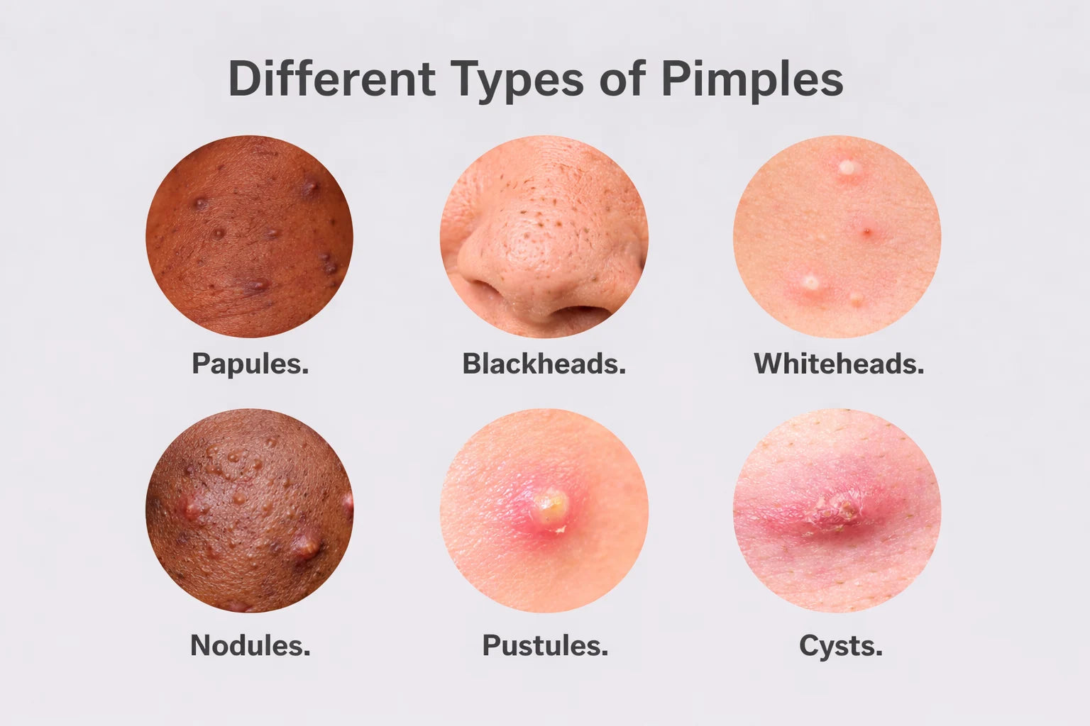 Diagram of the different types of pimples: papules, blackheads, whiteheads, nodules, pustules and cysts